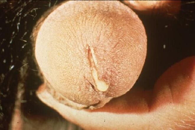 patologický hlen z penisu